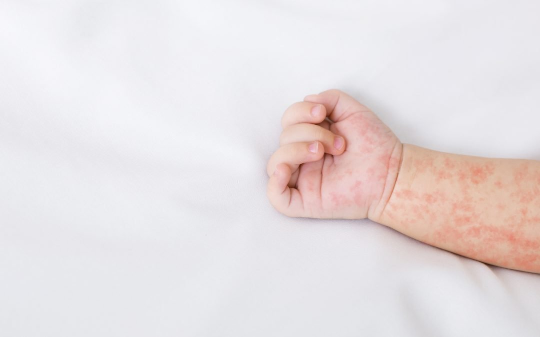 Is The Measles Vaccine Necessary for My Child? 